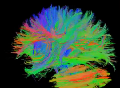 An MRI scan of the brain. Chinese researchers have found evidence that internet 'addiction' can cause the links between parts of the brain to be frayed.