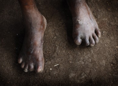 File photo of the feet of a man with leprosy in East Timor. Leprosy is still relatively common in east Asia, with over 150,000 new cases a year diagnosed in India.