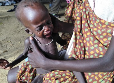 A mother holds her malnourished child at a hospital run by Medecins Sans Frontieres earlier this month.