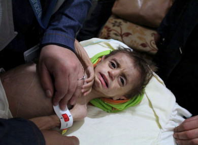 UN treat a malnourished child in a hospital near Damascus