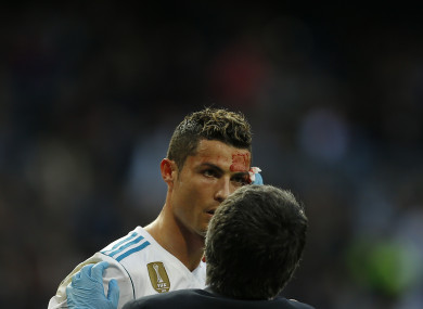 Real Madrid's Cristiano Ronaldo bleeds from his forehead during a La Liga match between Real Madrid and Deportivo Coruna.