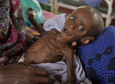 Seven month old Somlai boy Minhaj Gedi Farah is treated in a field hospital in Dadaab, Kenya.