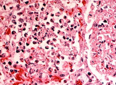 Legionnaire's disease