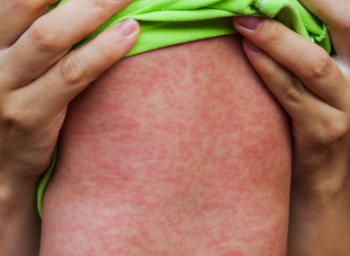 Measles rash